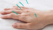 accupuncture-2-240x160