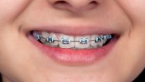 KidNeedBraces-istock